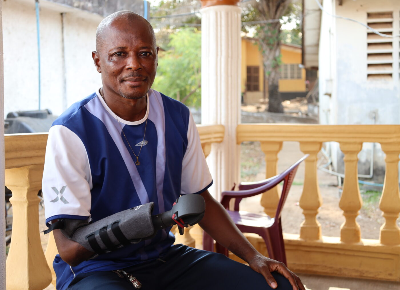 A man with a prosthetic arm is sitting on a porch, looking at the camera. He is wearing a blue and white shirt and dark pants. The prosthetic arm is gray and black, with a red accent. In the background, there's a house with a white wall and a brown railing, and some greenery.
